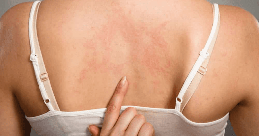 What Does Hepatitis C Rash Look Like：Early Detection, Better Treatment